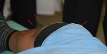 膝痛に対する鍼治療